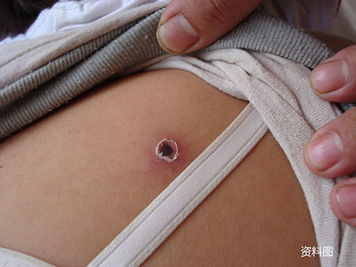 菜农上山割个草回来染上恙虫病