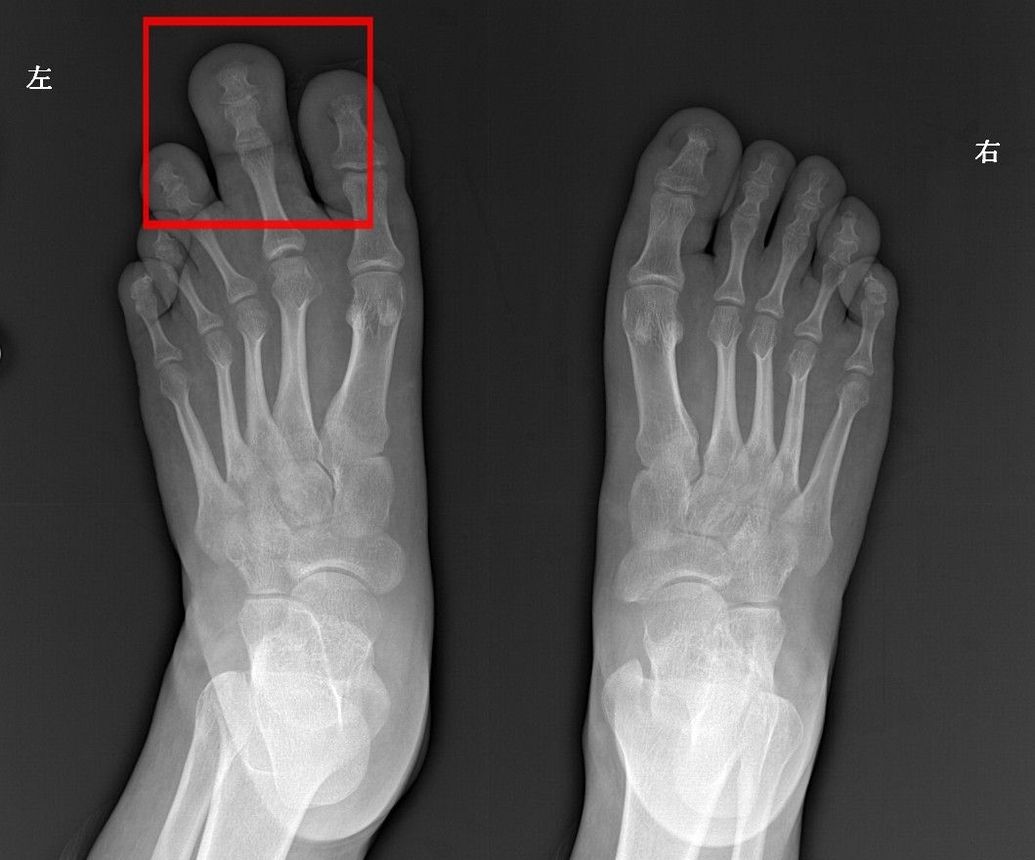 中山男子20年没有合穿的鞋子,原因很罕见