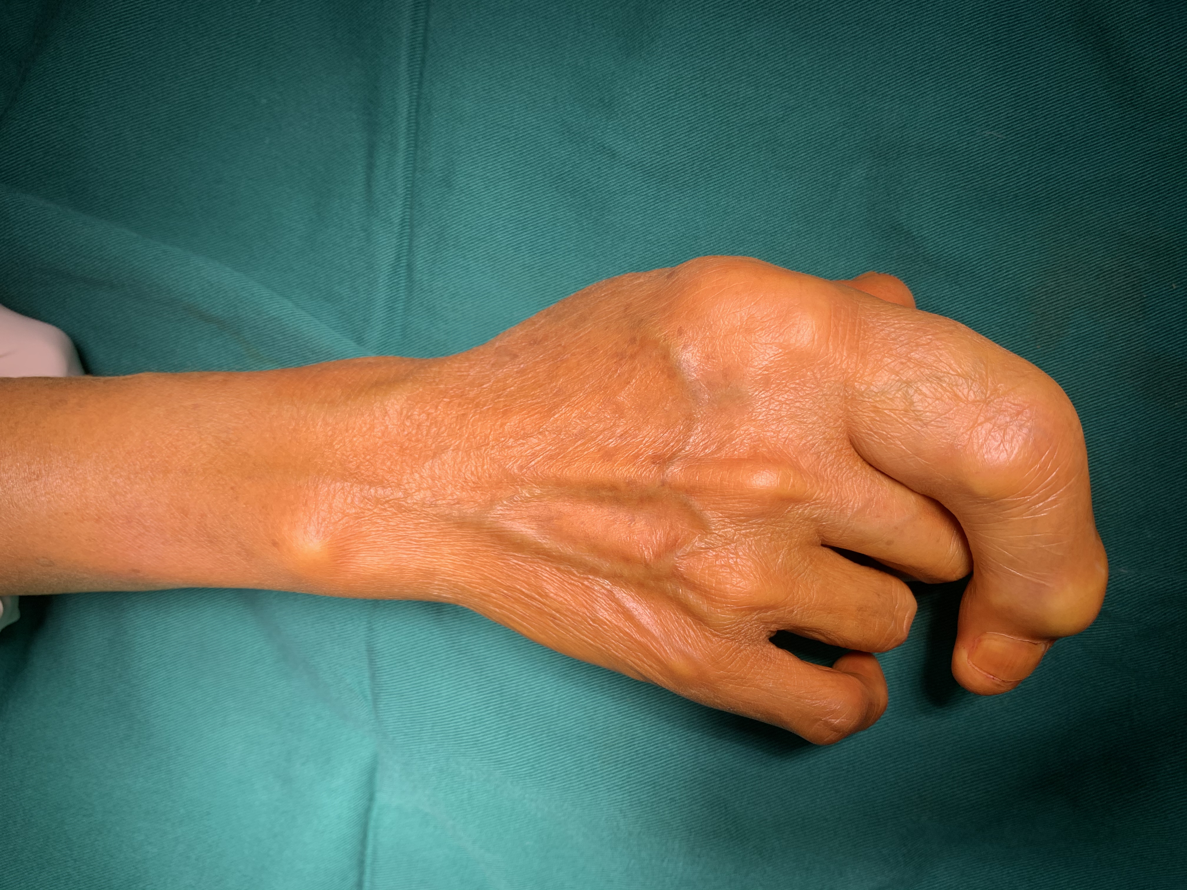 罕见巨指症困扰50年,今朝妙手回春笑颜开,多图!胆小者慎点